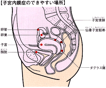 子宮内膜症のできやすい場所解説図